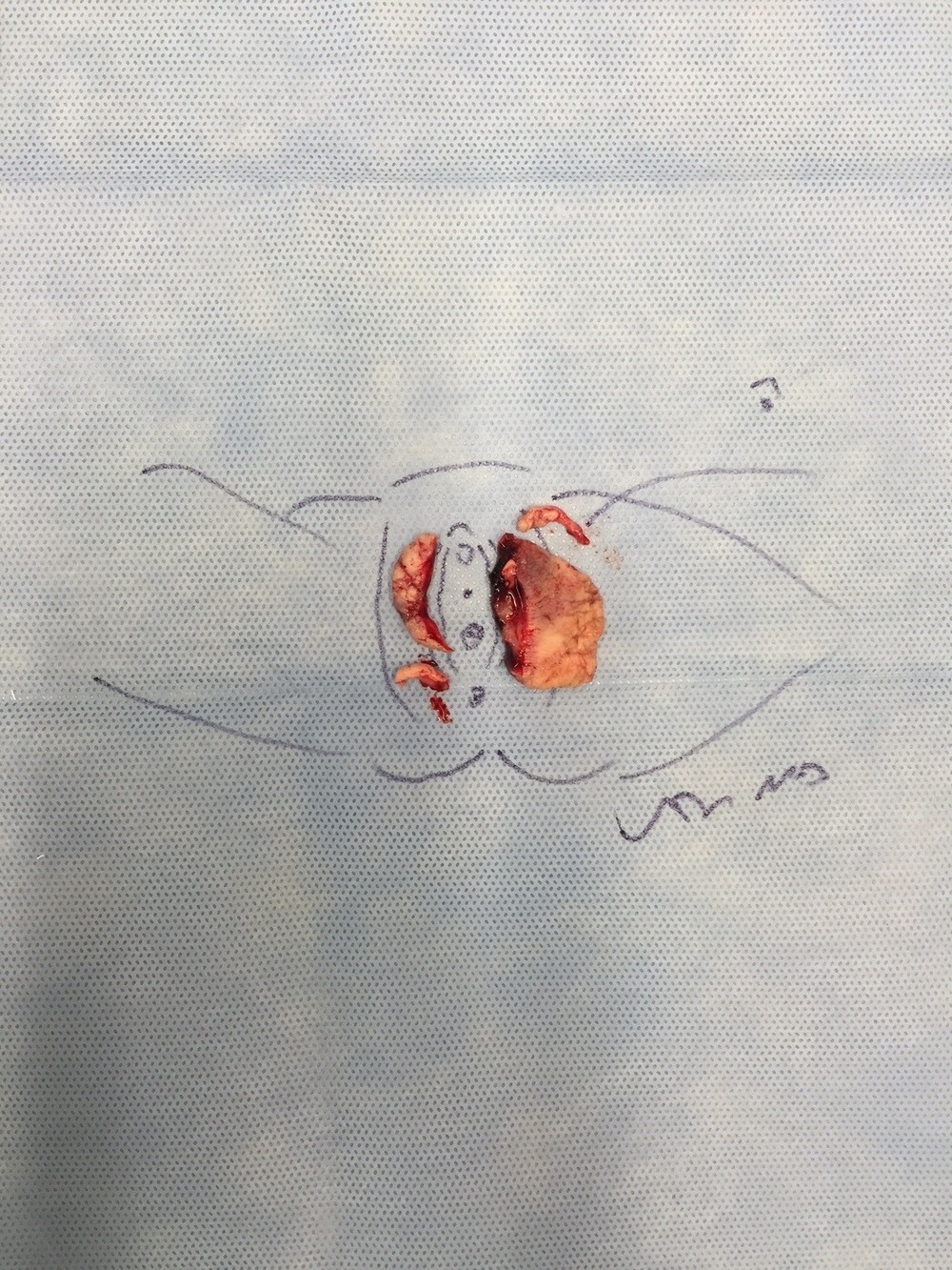 Vaginal mutilation — 10
