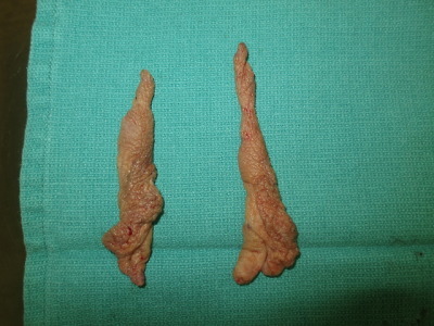 Vaginal mutilation — 6